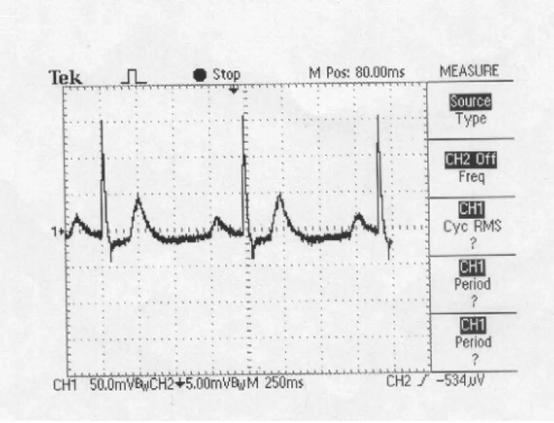 Hình 5: Dạng tín hiệu bệnh thấp tim (PQ dài ra) do máy phát mô phỏng  