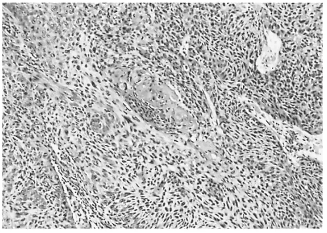 Hình 1.2: Carcinôm tế bào gai của âm đạo 